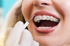 sivas ortodonti diş teli uygulaması