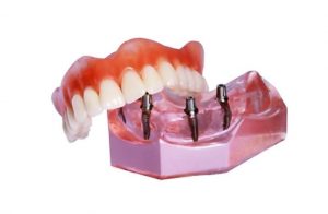 fransa diş implant 